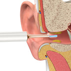 Bebird T15 Smart Visible Luminous Ear Pick Set